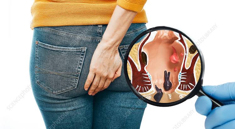 ॲनोरेक्टल विकार